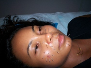acupuntura