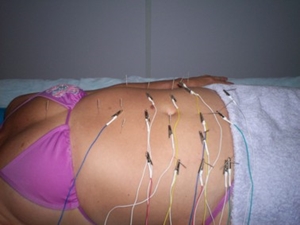 acupuntura